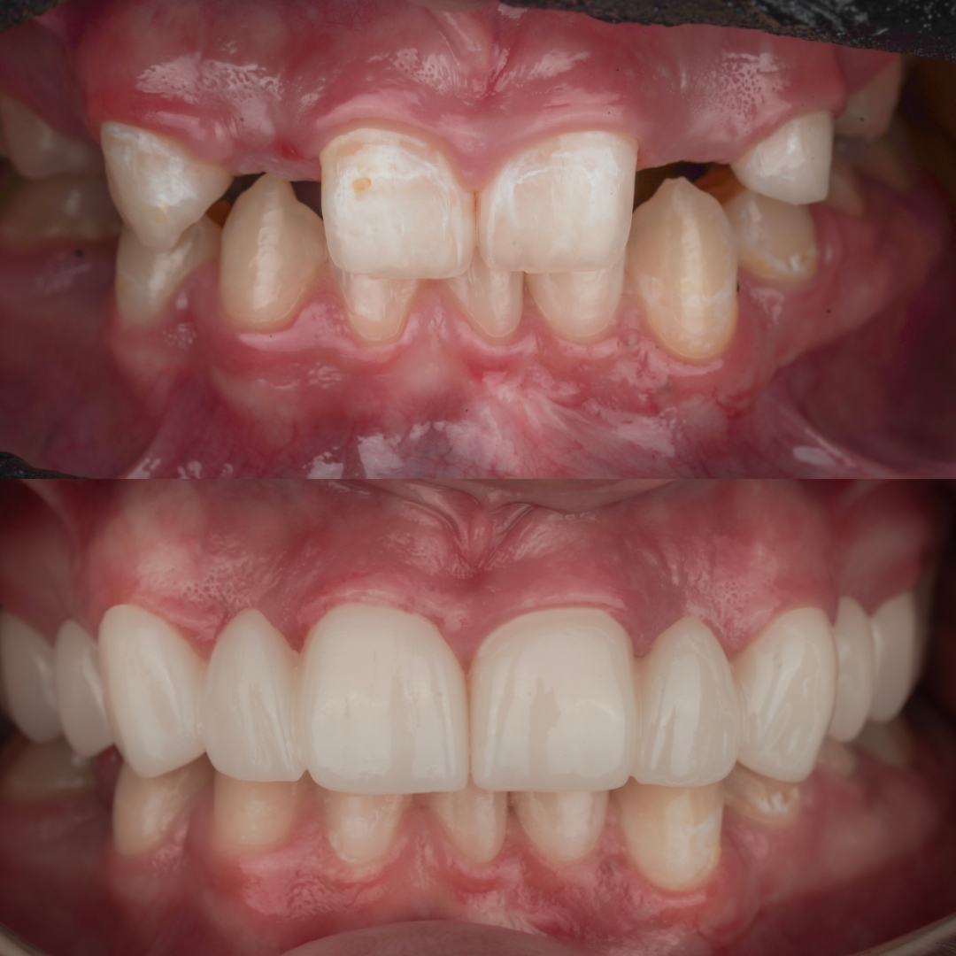 Dental bridge before and after