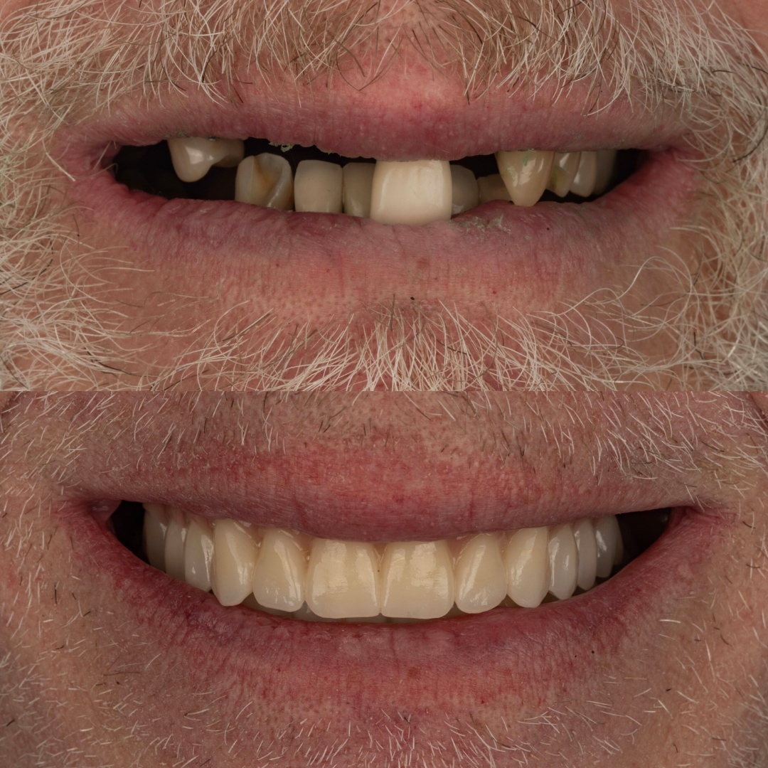Before and after dental transformation