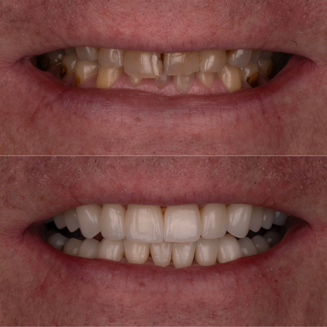 Before and after dental transformation