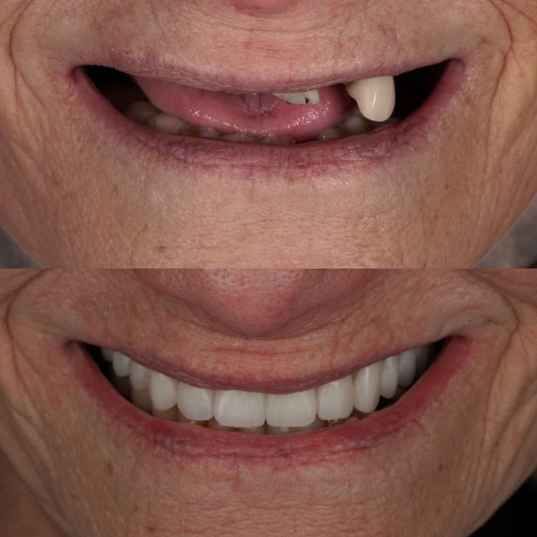 Complete dentures before and after