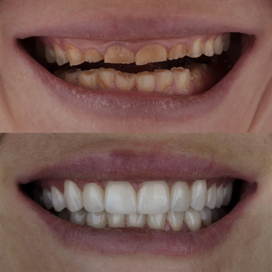 Before and after dental transformation