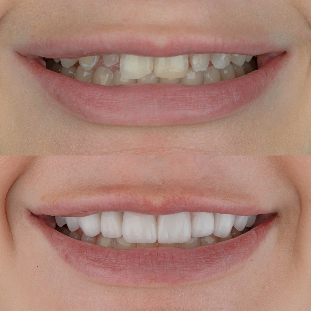 Porcelain veneers before and after