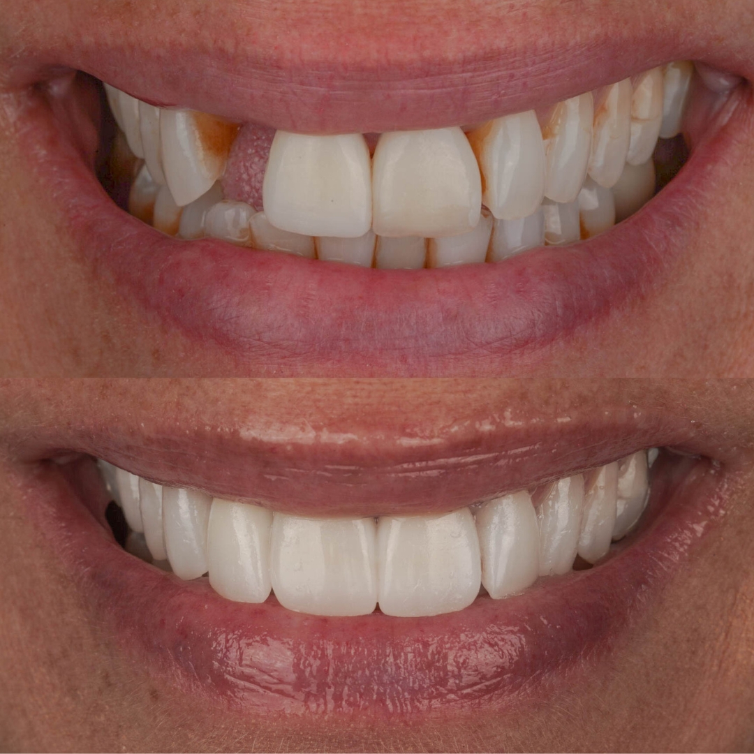 Before and after dental transformation