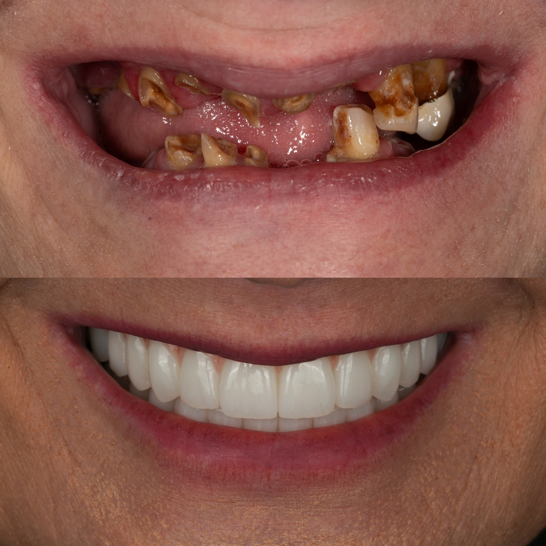 Upper and lower All-on-X before and after