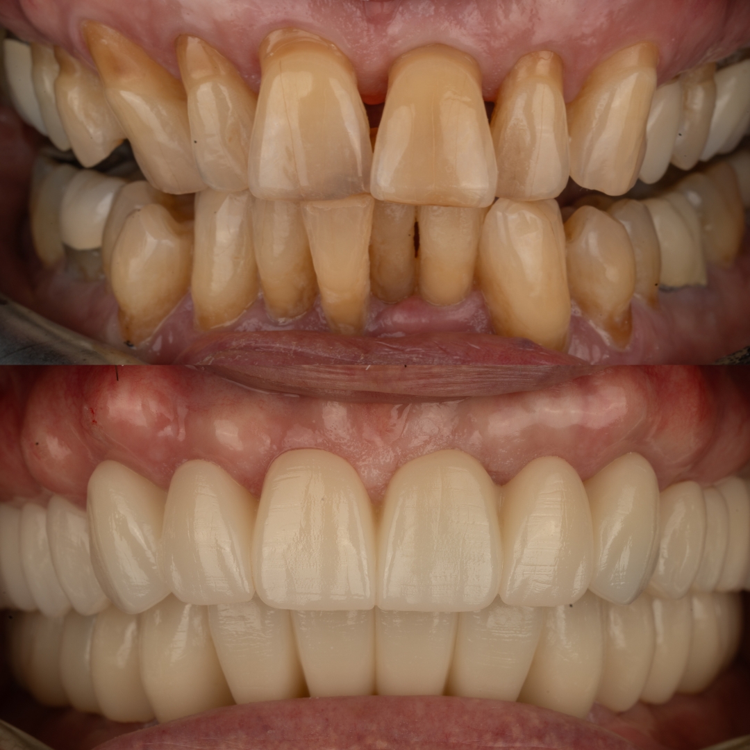 Before and after dental transformation