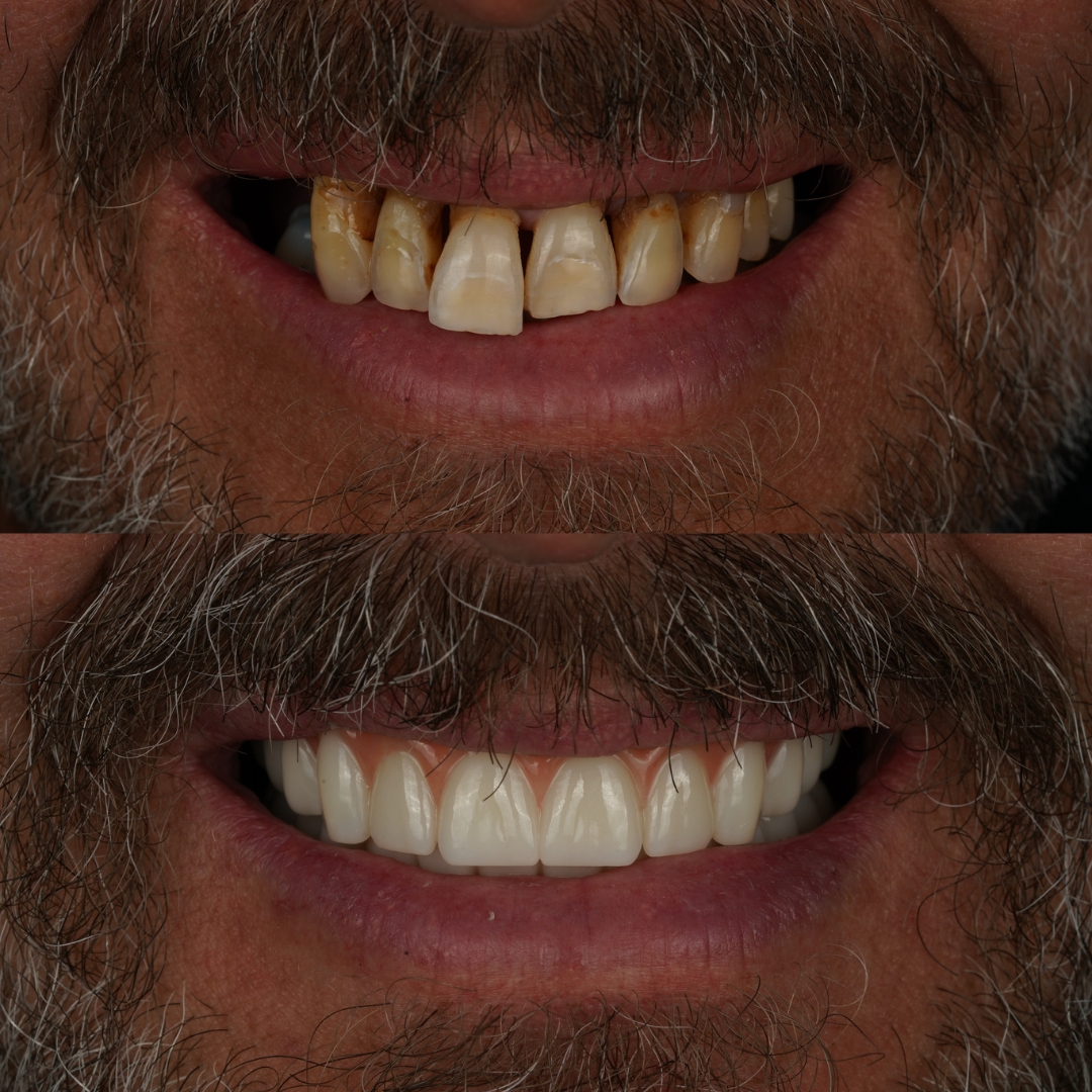 Before and after dental transformation