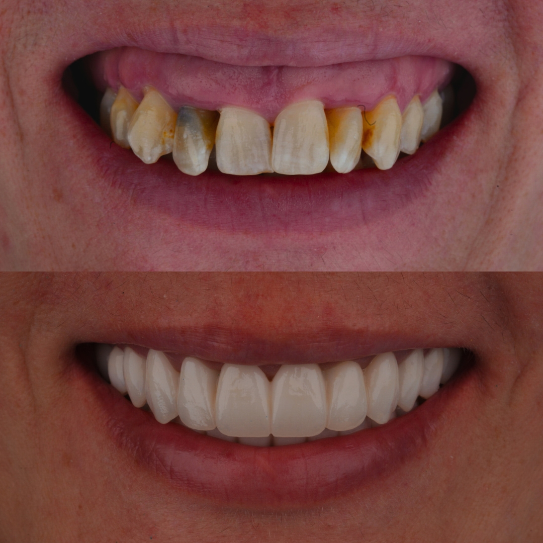 FP1 hybrid dentures before and after