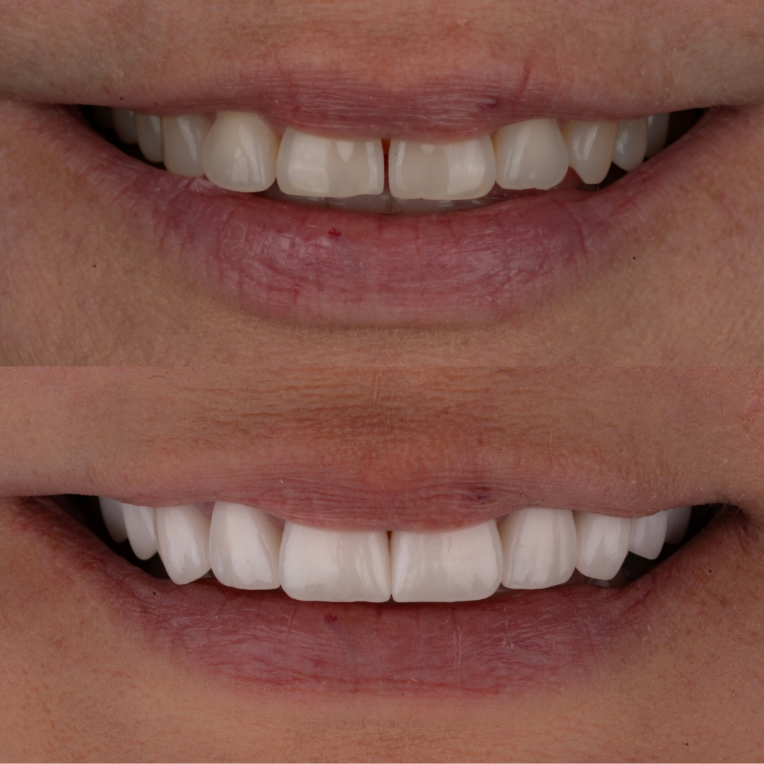 Before and after dental transformation