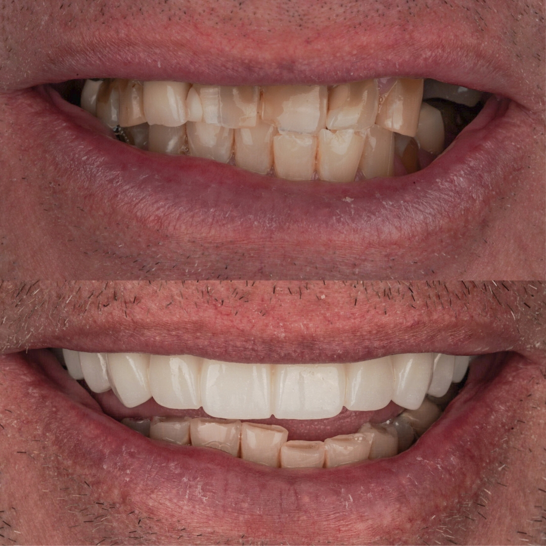 Upper FP1 restoration before and after