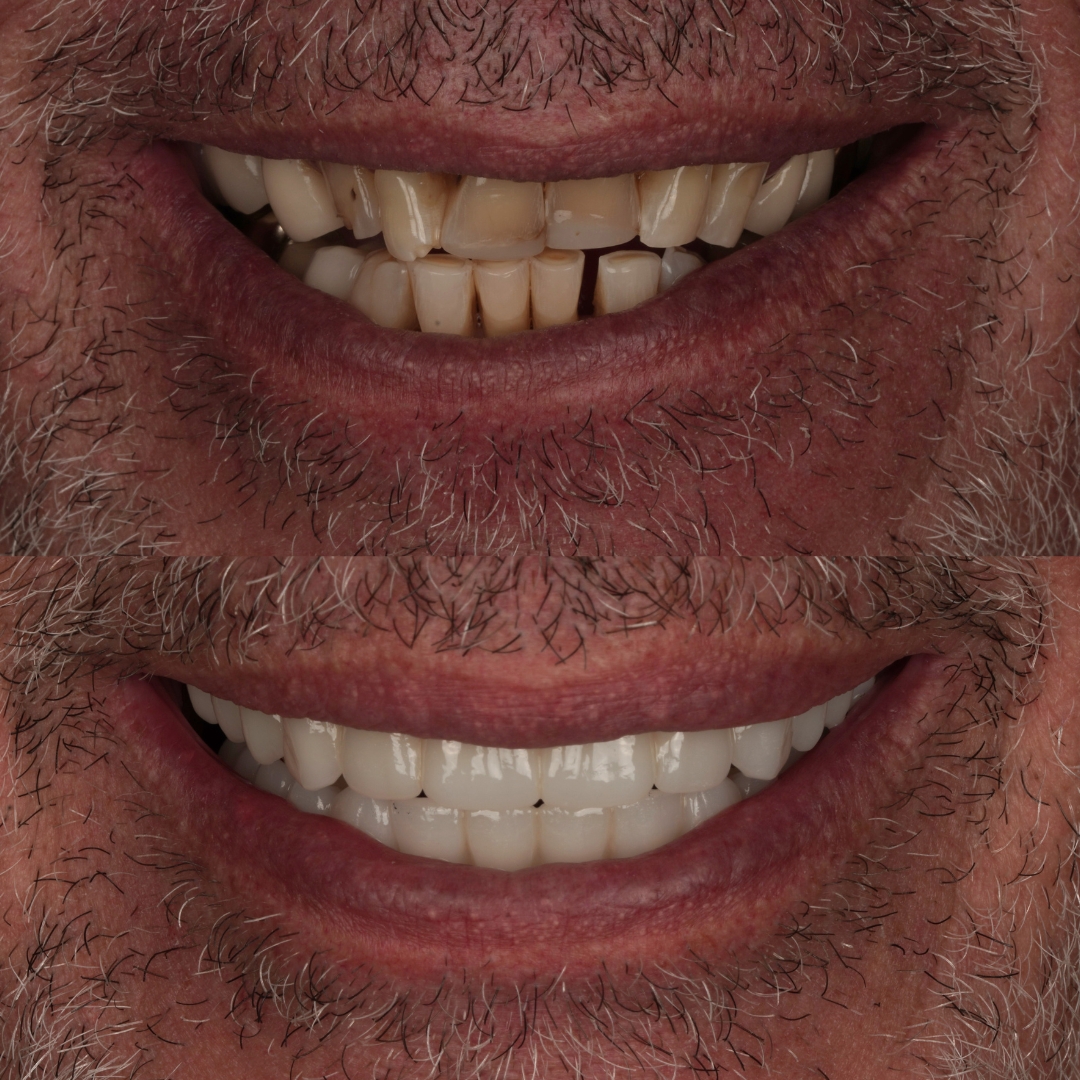 All-on-4 dental implants before and after