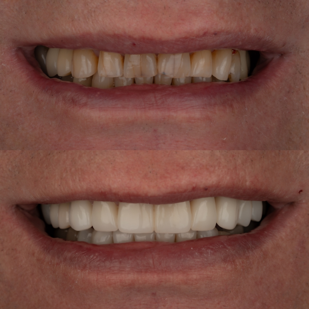 Custom crowns before and after