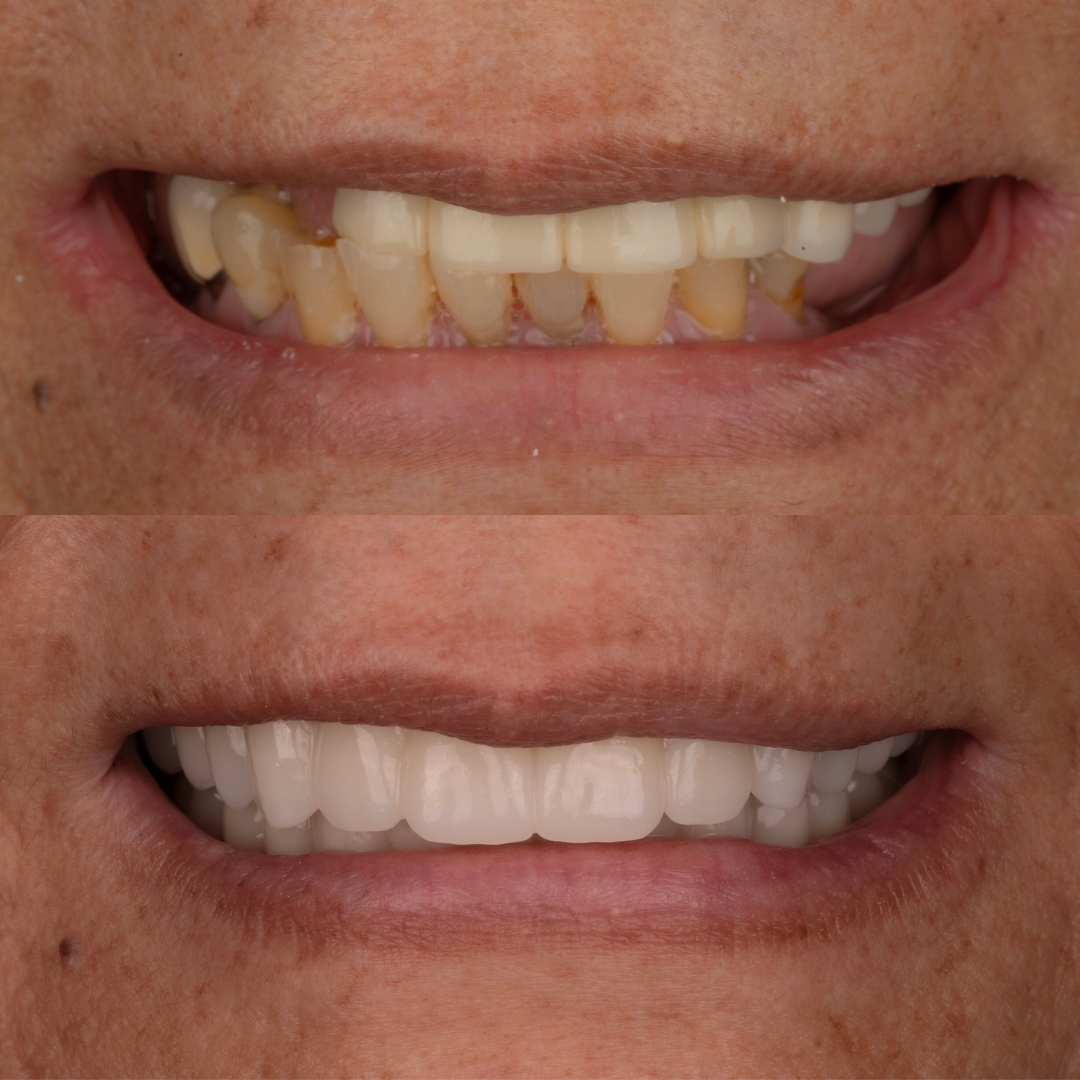 Before and after dental transformation
