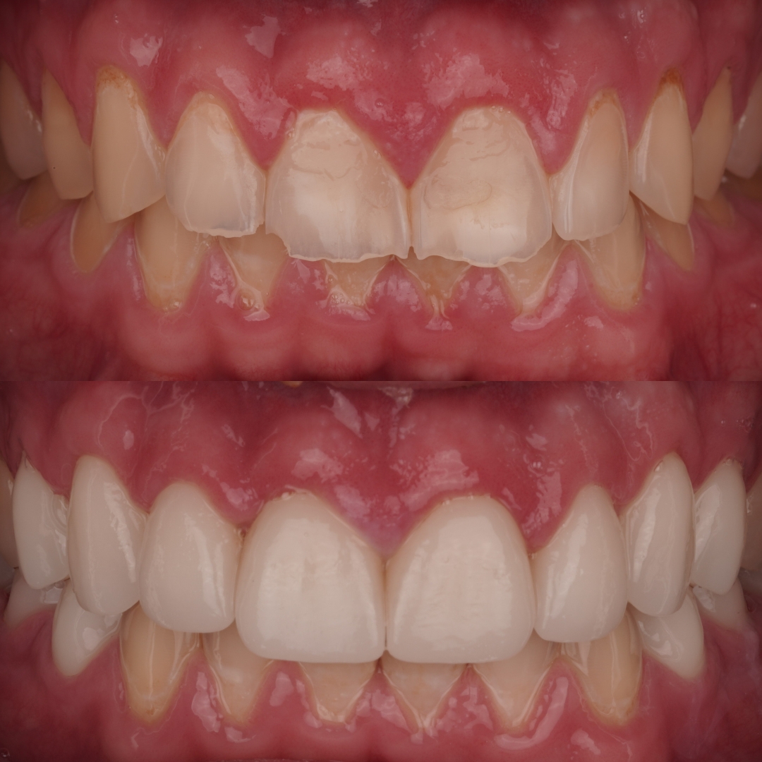Before and after dental transformation