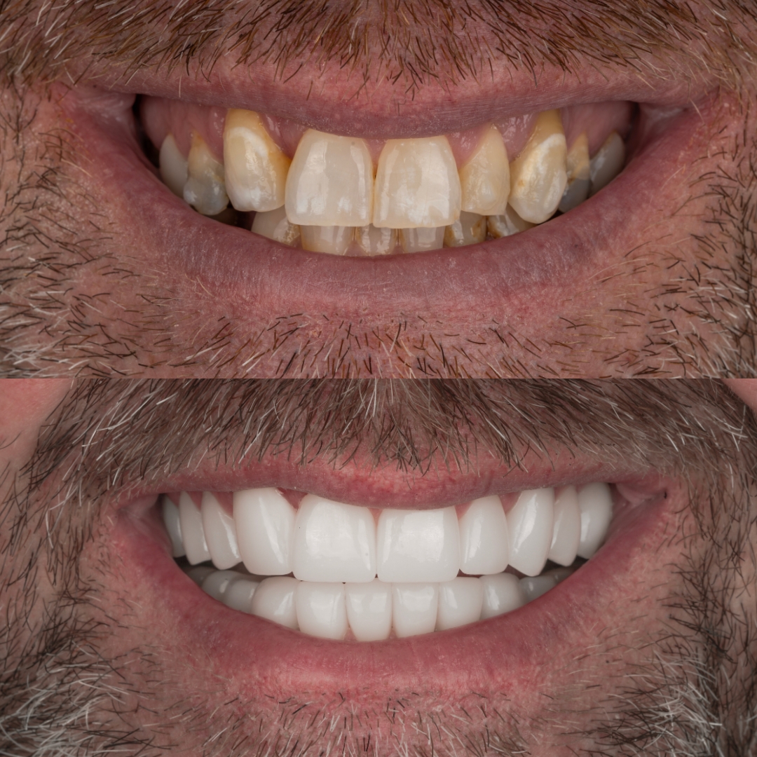Dental implants and crowns before and after