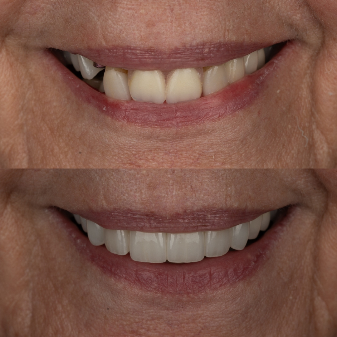 Dental implant before and after