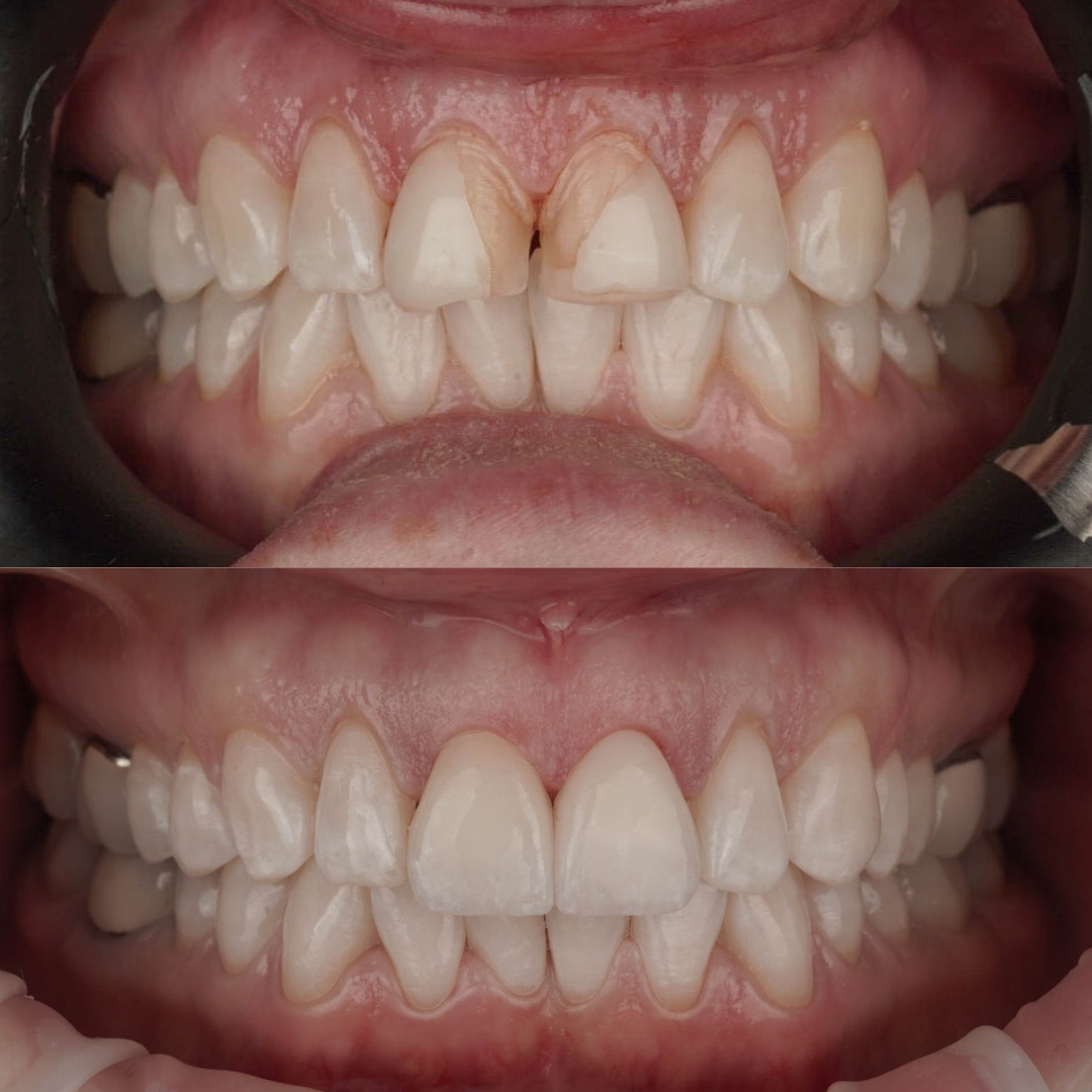 Porcelain veneers before and after