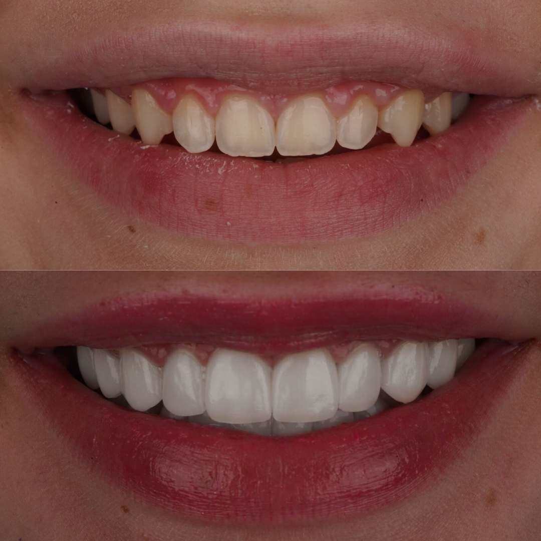 Porcelain veneers before and after