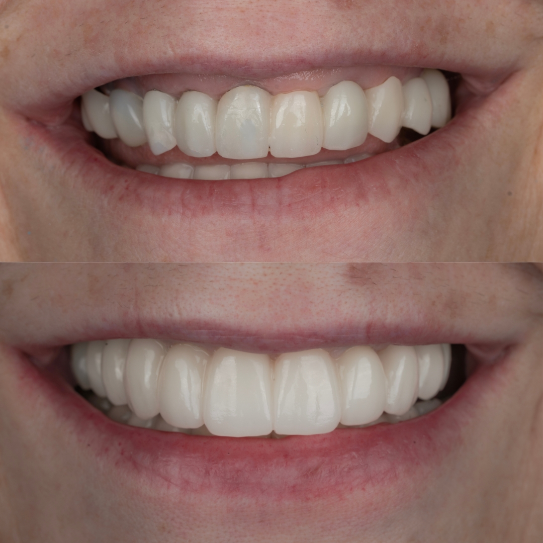 Implant-supported bridge before and after