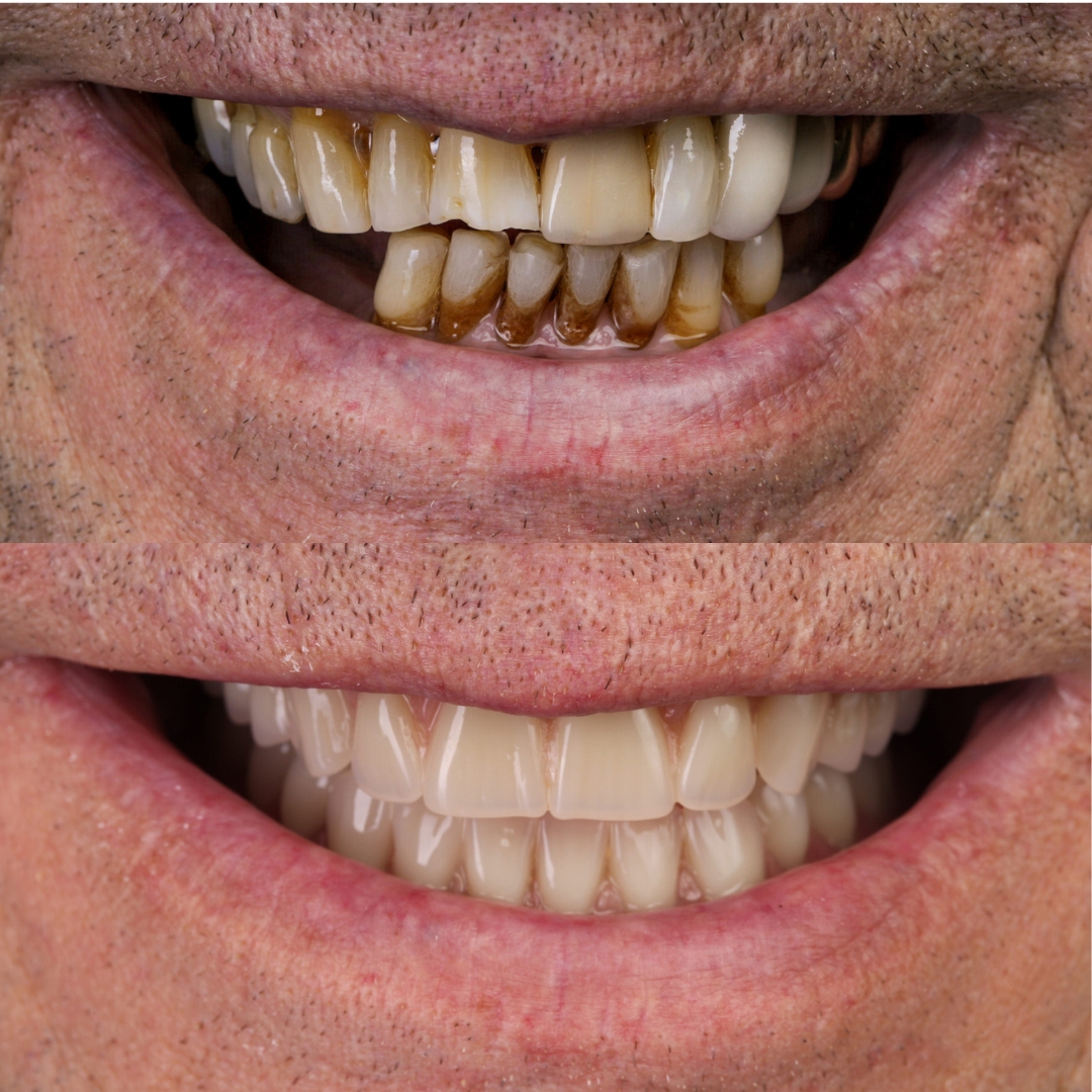 Snap-in dentures before and after