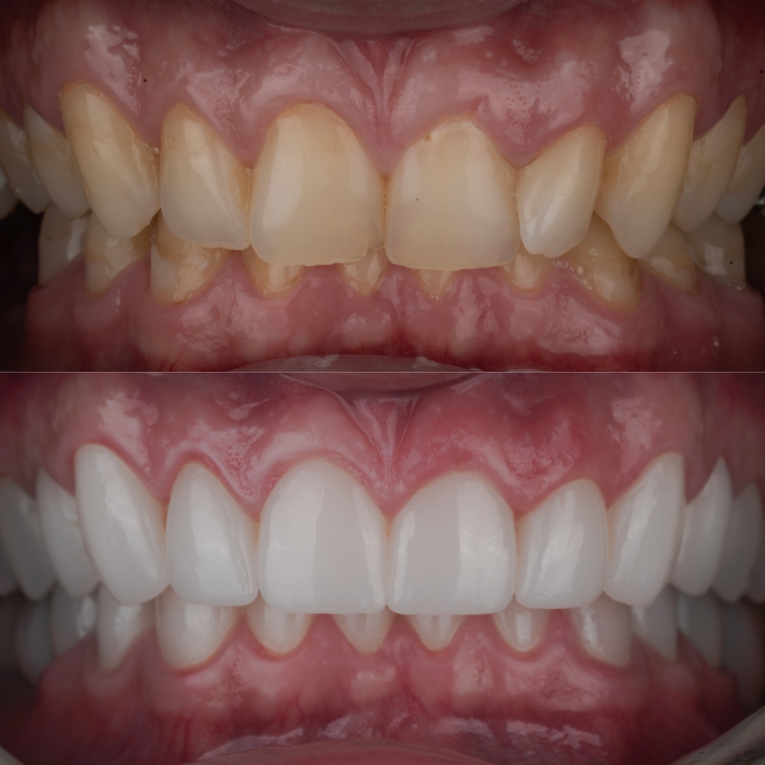 Veneers and crowns before and after