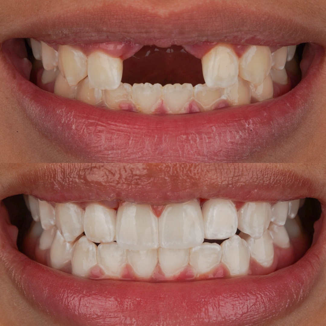 Before and after dental transformation